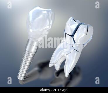 3D-Darstellung eines gebrochen weißen Zahn ein Zahn Implantat Stockfoto