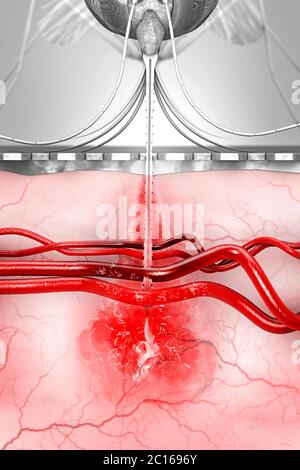 Eine Malaria-infizierte Mücke überträgt Malariaerreger bei Mückenstichen auf den menschlichen Blutkreislauf - 3D-Illustration Stockfoto