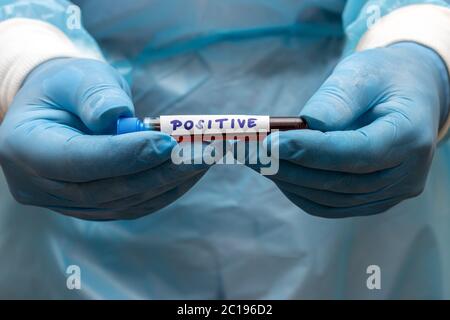 Ein Arzt zeigt ein Reagenzglas mit positiven Ergebnissen. Hand mit Handschuhen, die ein Reagenzglas mit Blut hält. Ein Labor Forschung des Blutes. Stockfoto