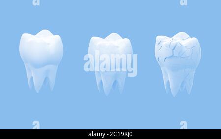 Gebrochene Backenzähne Zahn und ganzer Zahn isoliert auf blauem Hintergrund. 3d-Illustration Stockfoto