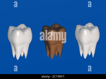 Braun befallenen Zahn, Karies, dunklen Zahn. 3d-Illustration Stockfoto