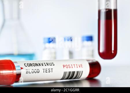 Probenfläschchen mit Blut, Etikett sagt Coronavirus-Test, positives Ergebnis (Aufkleber ist eigenes Design, Dummy-Barcode). Covid-19-Ausbruchskonzept Stockfoto
