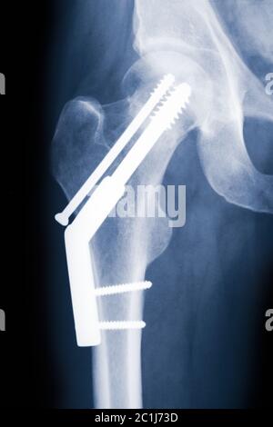 Hip-Röntgenaufnahme mit Fixierung einer gebrochenen Hüfte mit einer dynamischen Hüftschraube und einer Anti-Rotations-Schraube. Stockfoto