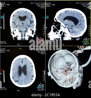 CT-Scans des menschlichen Kopfes Stockfoto