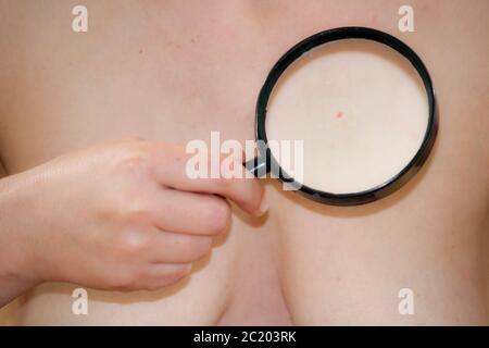 Untersuchung von Hautkrebs Stockfoto