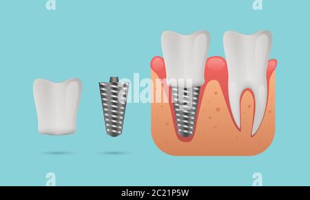 Zahnimplantatstruktur, menschliche Zähne und Zahnimplantat, Vektordarstellung Stock Vektor