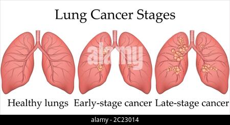 Vektor medizinische Illustration des menschlichen Lungenkrebs Entwicklungsprozess. Stadien von Lungenkrebs von gesunden Lungen bis zum letzten Stadium. Poster für Krankenhaus Stock Vektor