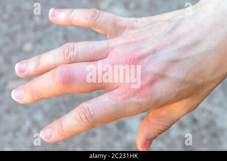 Rechte Hand mit einem geschwollenen großen Mittelfinger nach einem Bienenstich, vergrößert durch Allergiereaktion nach einem Wespenstich, rote Empfindung an Stockfoto