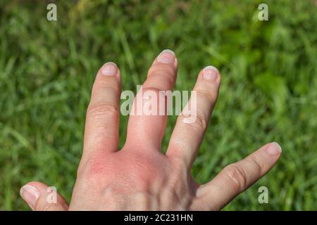 Rechte Hand mit einem geschwollenen großen Mittelfinger nach einem Bienenstich auf grünem Hintergrund, größer durch Allergiereaktion nach einem Wespenstich, rotes Gefühl Stockfoto