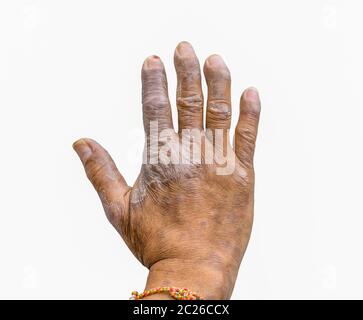 Nahaufnahme der Psoriasis an den Händen der Landwirte auf weißem Hintergrund, Dermatologie Haut Krankheit. Psoriasis finger Deformität. Stockfoto