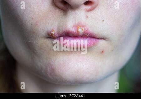 Herpes-Krankheit auf den Lippen eines jungen Mädchens. Wunden von Herpes auf den Lippen einer Person. Herpes foci. Stockfoto