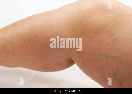 Patient mit Krampfadern auf Beinen auf weißem Hintergrund Stockfoto