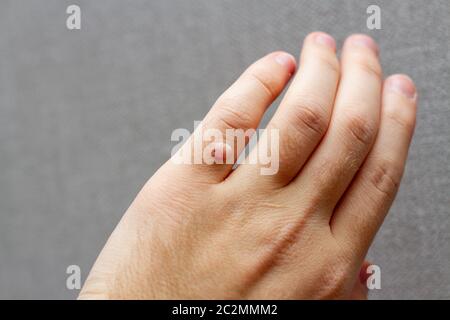 Finger Warze auf der Hand. Gesundheitskonzept. Stockfoto