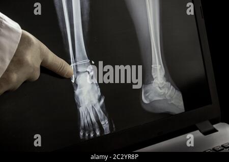 Röntgenaufnahme des Beins nach der Operation - Drähte im Bein. Der Arzt zeigt mit dem Finger auf den operierten Bereich. Stockfoto