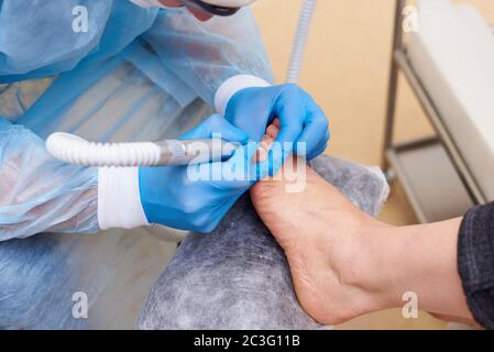 Behandlung von Pilzerkrankungen der Haut der Füße und Nägel. Stockfoto