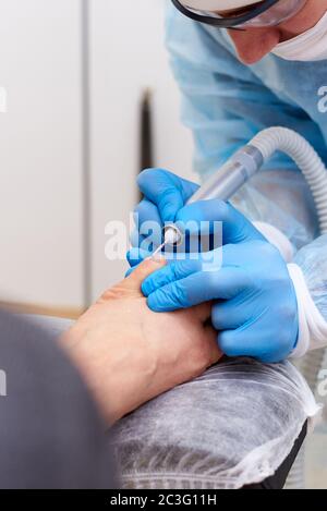 Behandlung von Pilzerkrankungen der Haut der Füße und Nägel. Stockfoto