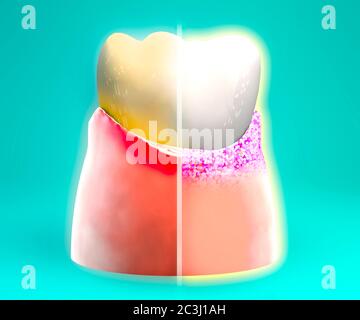 Zahn, Wunde Zahnfleisch, Rötung, Zahnmedizin, Zahnreinigung, Mundhygiene. Mit Zahnpasta, um den Zahn vor Plaque Bildung zu schützen, 3d-Rendern Stockfoto