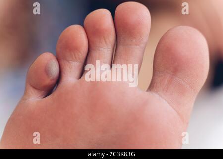 Nahaufnahme des menschlichen Fußfingers mit einer großen Blister auf der Innenseite des Fußes Stockfoto