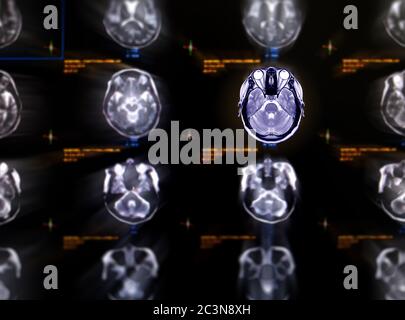 Selektive Fokussierung des MRT-Gehirns axiale Ansicht für die Detektion einer Vielzahl von Bedingungen des Gehirns wie Zysten, Tumoren, Blutungen, Schwellungen, Entwicklung und s Stockfoto