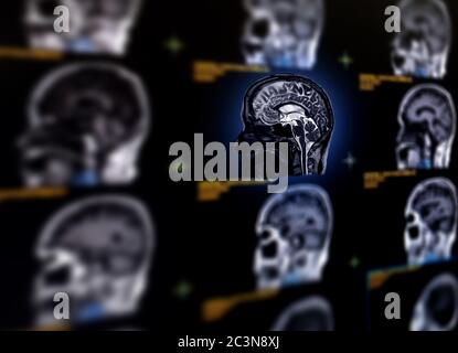 Selektive Fokussierung der sagittalen MRT-Hirnebene zur Erkennung einer Vielzahl von Erkrankungen des Gehirns wie Zysten, Tumoren, Blutungen, Schwellungen, Entwicklung A Stockfoto