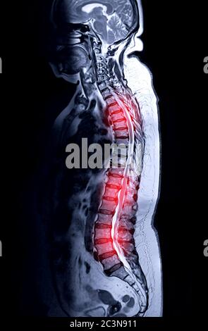 MRT-Ganzdorn-Screening zur Diagnose Rückenmarkskompression. Stockfoto