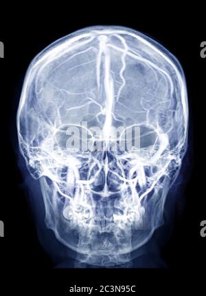 Schädel-Röntgenbild des menschlichen Schädels AP-View-Mix mit MRV Hirnbild mit venösen Nasennebenhöhlen des Gehirns im Schädel. Stockfoto