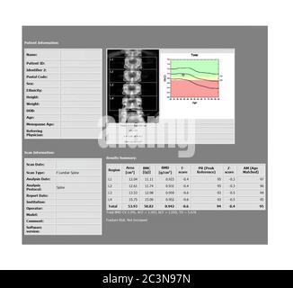 DEXA Densitometry Bericht der Lendenwirbelsäule Scan für Osteopenia vorhanden, häufige Vorläufer der Osteoporose. Stockfoto