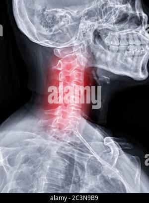 Röntgenaufnahme der C-Wirbelsäule oder Röntgenaufnahme der schrägen Ansicht der Halswirbelsäule für diagnostische Bandscheibenvorfall. Stockfoto