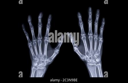 röntgenbild der beidhändigen AP-Ansicht isoliert auf schwarzem Hintergrund für diagnostische rheumatoide Diagnostik. Stockfoto