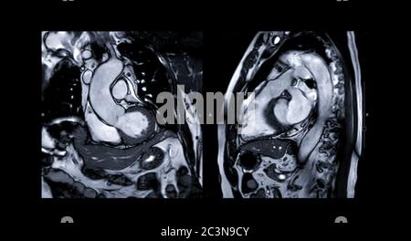 MRT Herz oder Herz MRT (Magnetresonanztomographie) des Herzens vergleichen RVOT und LVOT für die Diagnose Herzerkrankungen. Stockfoto