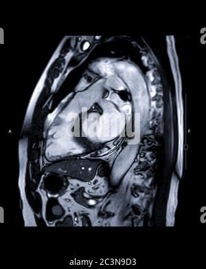 MRT Herz oder Herz MRT ( Magnetresonanztomographie ) des Herzens LVOT Ansicht für die Diagnose Herzkrankheit. Stockfoto