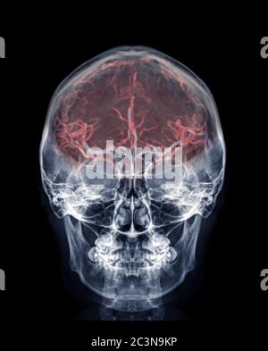 Schädel Röntgenbild des menschlichen Schädels AP-Ansicht zeigt die Hirnarterie im Schädel . Stockfoto
