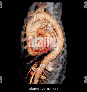 3D-Rendering-Bild der thorakalen Aorta CTA für diagnostische abdominale Aortenaneurysmen oder AAA- und Aortendissektion Stockfoto