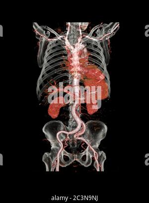 3D-Rendering-Bild der Aorta abdominal mit CTA-Dissektion und transparentem Knochen. Stockfoto