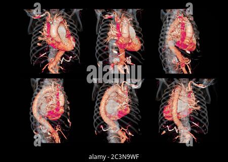 Sammlung von 3D-Rendering-Bildern der CTA-Thoraxaorta für diagnostische abdominale Aortenaneurysmen oder AAA- und Aortendissektion Stockfoto