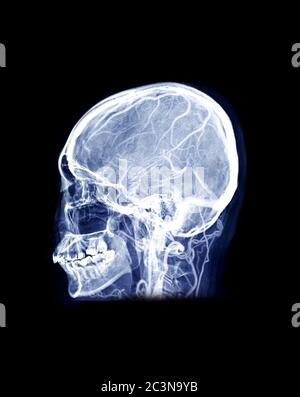 Schädel Röntgenbild des menschlichen Schädels Lateral Mix MRV Gehirnbild mit venösen Nebenhöhlen des Gehirns im Schädel. Stockfoto