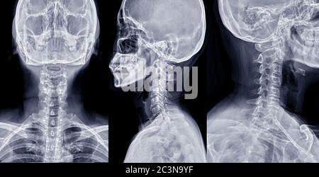 Aufnahme von Röntgenaufnahmen der C-Wirbelsäule oder Röntgenaufnahmen der Halswirbelsäule AP , laterale und schräge Ansicht für diagnostische Bandscheibenvorfall. Stockfoto