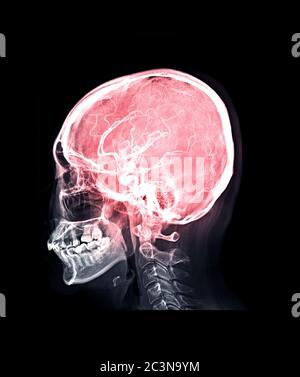 Schädel Röntgenbild des menschlichen Schädels Lateral Mix MRV Gehirnbild mit venösen Nebenhöhlen des Gehirns im Schädel. Stockfoto