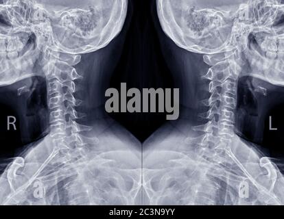 Aufnahme von Röntgenaufnahmen der C-Wirbelsäule oder Röntgenaufnahmen der Halswirbelsäule schräge Ansicht auf beiden Seiten für diagnostische Bandscheibenvorfall. Stockfoto