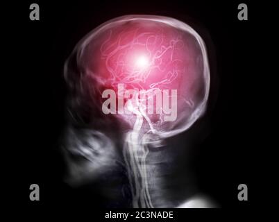 Selektiver Fokus des Schädel-Röntgenbildes der lateralen Ansicht des menschlichen Schädels Fusion mit MRA Brain image . Stockfoto