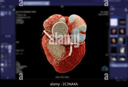 CTA Koronarararterie 3D-Rendering-Bild für die Feststellung koronarer Herzkrankheit auf verschwommenem Bildschirmhintergrund. Stockfoto