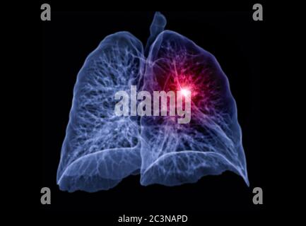 CT Chest oder Lunge 3D-Rendering-Bild links schräge Ansicht zeigt Läsion linken Bereich für die Diagnose TB, Tuberkulose und covid-19 . Stockfoto