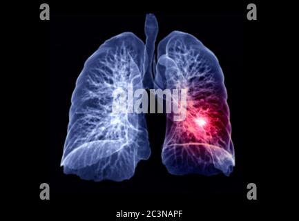 Selektiver Fokus der CT-Brust oder Lunge 3D-Rendering-Bild zeigt Läsion linken Bereich für die Diagnose TB, Tuberkulose und covid-19 . Stockfoto