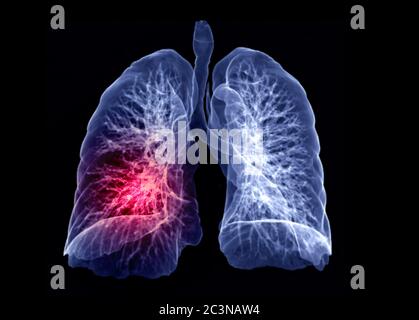 Selektiver Fokus von CT Chest oder Lung 3D Rendering Bild drehen sich auf dem Bildschirm für Diagnose TB, Tuberkulose und covid-19 . Stockfoto