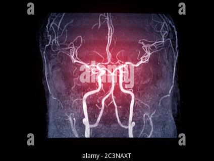 MRA Gehirn oder Magnetresonanzangiographie ( MRA ) der Hirnarterie im Gehirn für bewerten sie Stenose und Schlaganfall-Krankheit Stockfoto