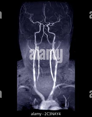 MRA Gehirn und Hals oder Magnetresonanzangiographie ( MRA ) der Hirnarterie und der gemeinsamen Halsschlagader zur Bewertung ihrer Stenose und Schlaganfall DIS Stockfoto