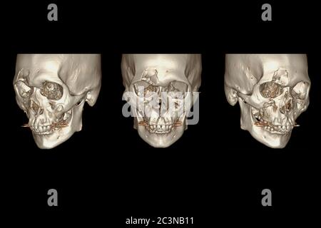 CT Facial Bone 3D Rendering-Bild isoliert auf schwarzem Hintergrund zeigt Bruch frontalen Knochen . Stockfoto