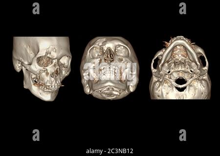 CT Facial Bone 3D Rendering-Bild isoliert auf schwarzem Hintergrund zeigt Bruch frontalen Knochen . Stockfoto