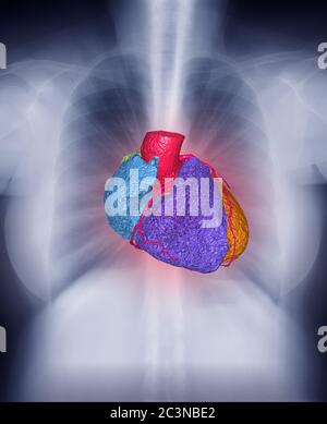 Fusionsbild des Röntgenbildes der Brust und 3D-CTA-Koronararararterie-Bild mit Herz im Brustkorb für das Kontrollkonzept. Stockfoto