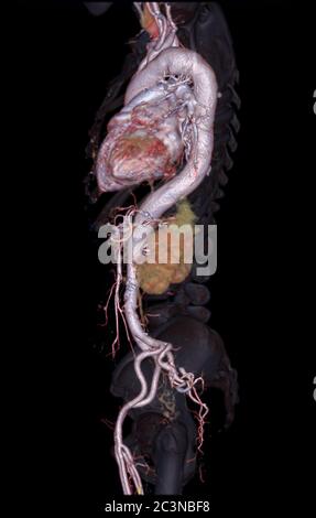 CTA Abdominal Aorta 3D-Rendering-Bild auf transparenten Skelett . Stockfoto